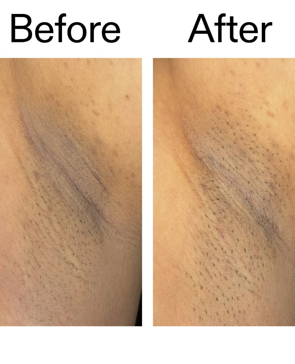 Stick Corps Exfoliant Anti-rougeurs